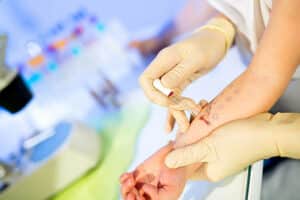 prick test allergia